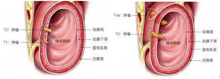 阿特蒙李进教授：读懂结直肠癌TNM分期及对应的治疗方案